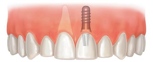 Имплантация - возвращаем утраченный зуб