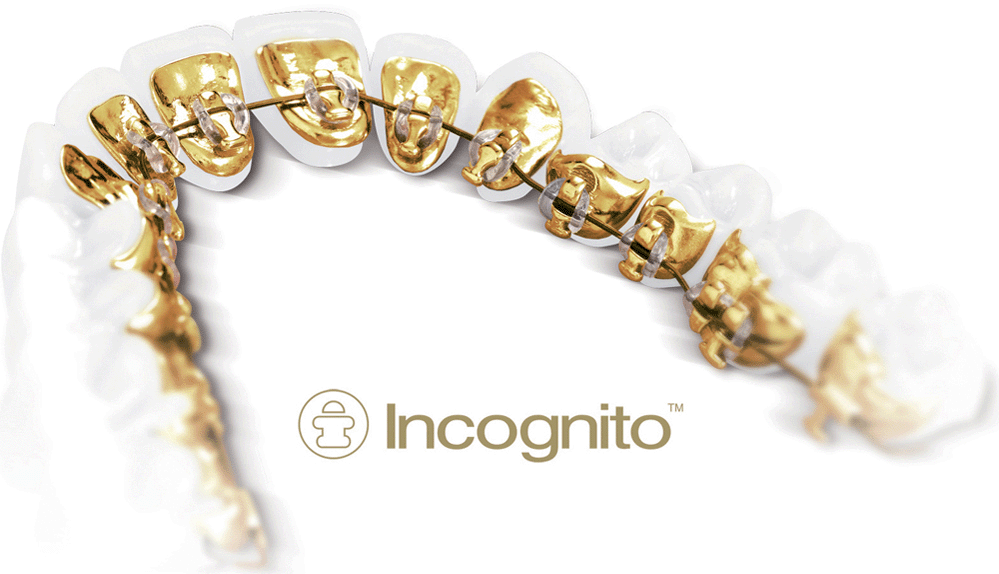 Невидимые брекеты “Incognito”