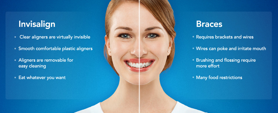 Невидимые “брекеты” “Invisalign”