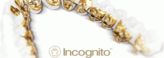Невидимые брекеты "Incognito"