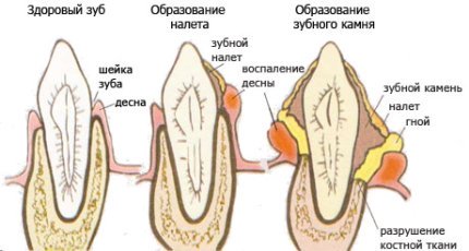 Зубной камень и быстрое его удаление