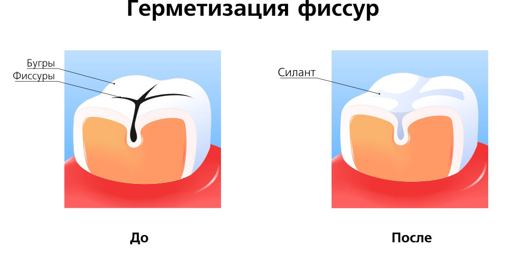 Герметизация фиссур