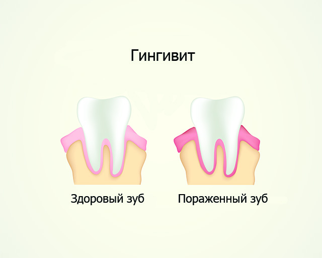 Гингивит. Лечение зубов