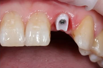 Имплантация зубов. Титановые или циркониевые импланты?