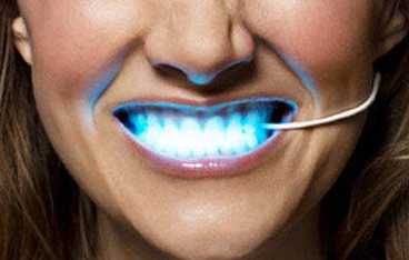 Лазерное отбеливание зубов и его преимущества