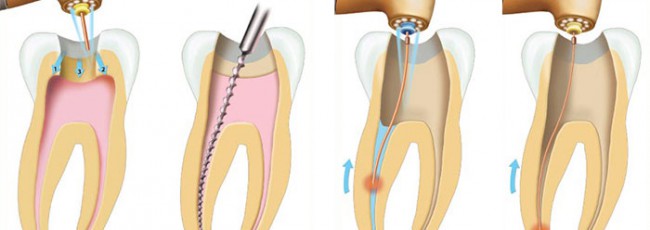 Лечение каналов зубов