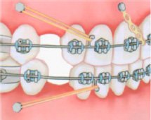Несъемные ортодонтические аппараты