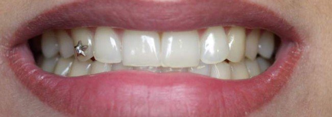 Что такое скайсы? Украшения для зубов