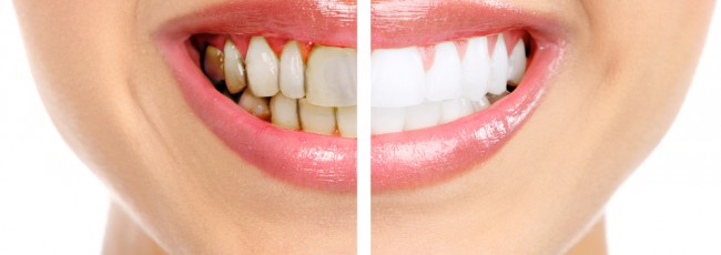 Эстетическая стоматология: профилактика зубного камня