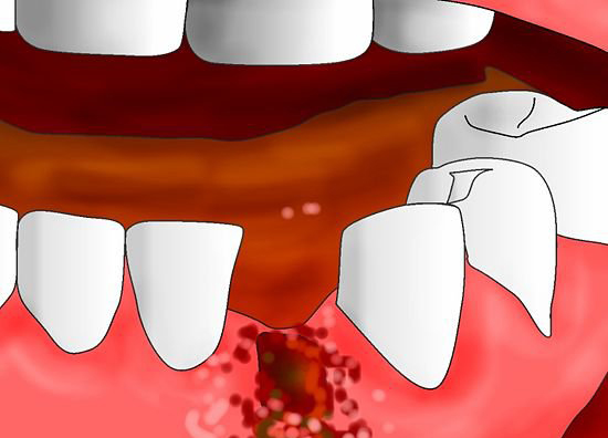 Остановить кровь после удаления зуба