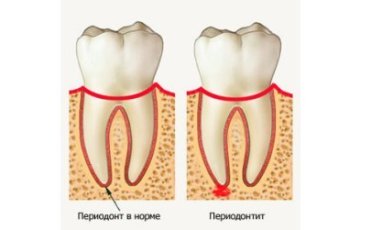 Болит зуб при надкусывании