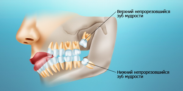 Проблемы с зубами мудрости