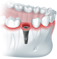 Методы имплантации зубов