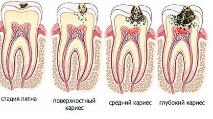 Классификация кариеса зубов человека