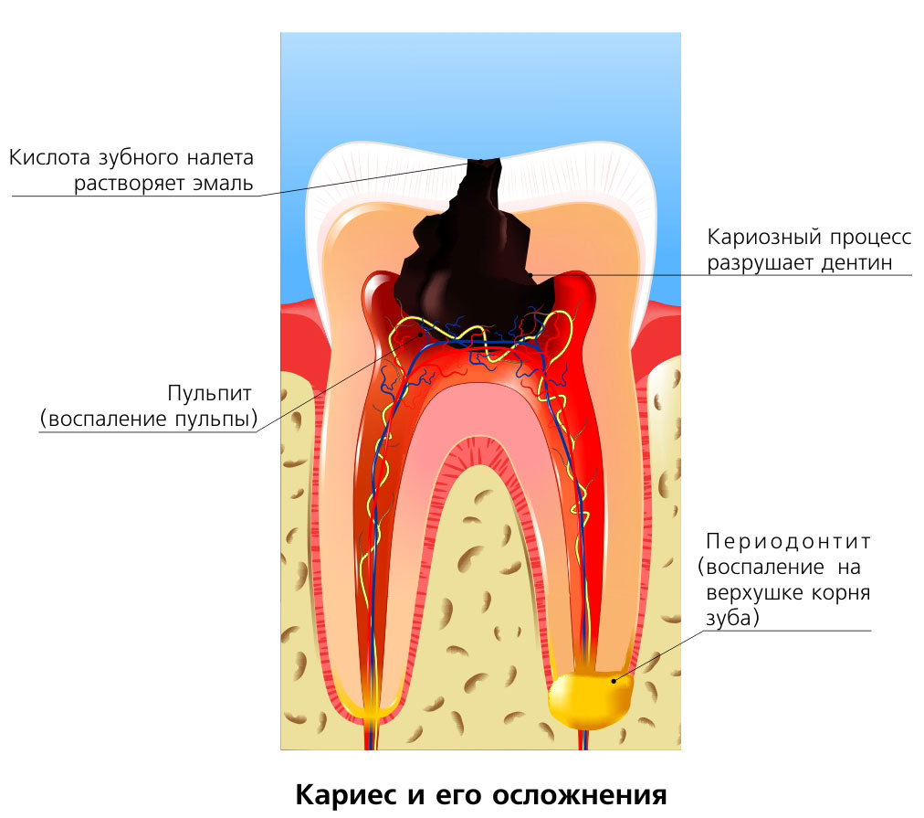 Где прячется кариес?
