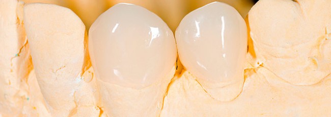 Классификация коронок в стоматологии