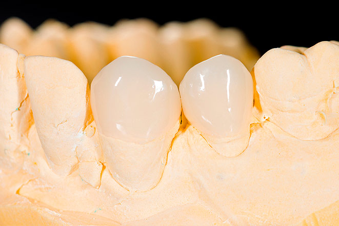 Классификация коронок в стоматологии