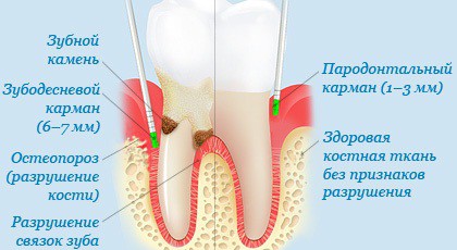 Кюретаж в стоматологии