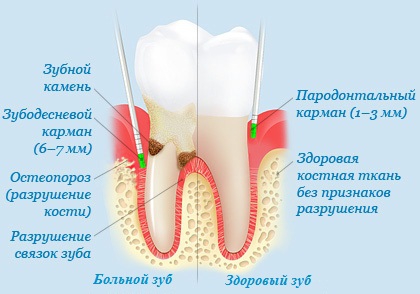 Кюретаж в стоматологии