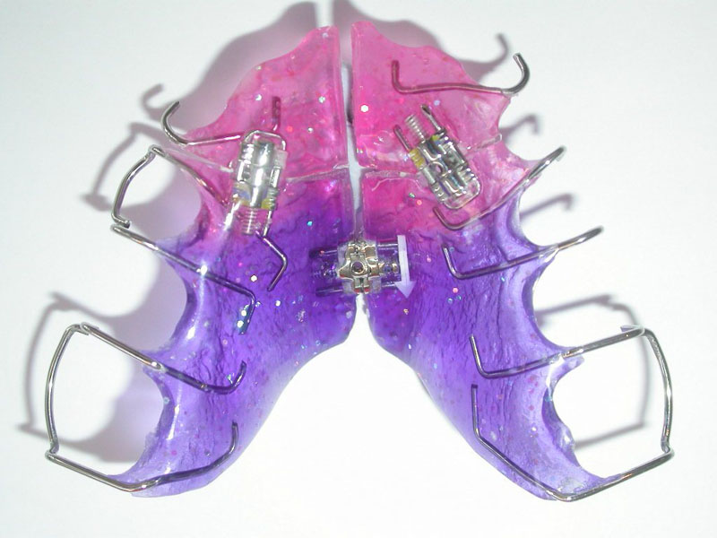 Исправление прикуса пластинками