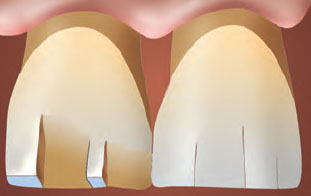 Трещины в эмали зубов