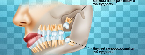 Проблемы с зубами мудрости