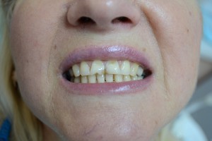 На передних зубах клиновидные дефекты и трещины