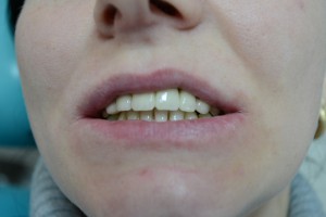 После протезирования зубов  металлокерамикой