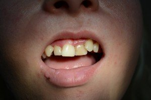 Ситуация до применения техники винирования зубов