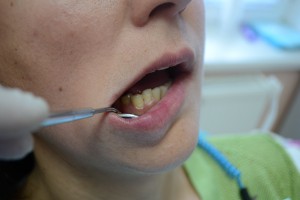 После пломбировки зуба фотополимером