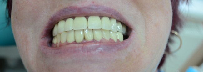 После протезирования зубов белыми коронками