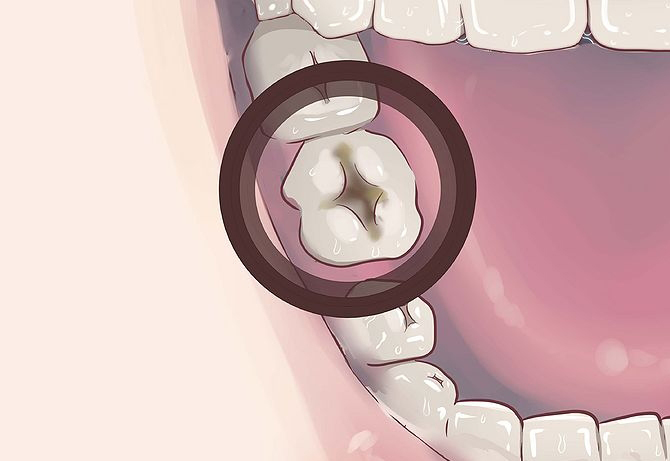 Каким образом лечат абсцесс зуба?