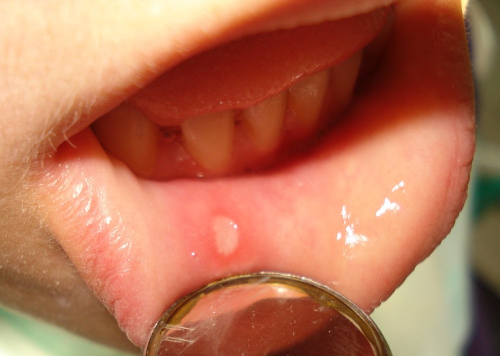 Герпетический стоматит у детей