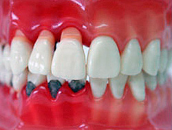 Как не потерять зубы на разных стадиях пародонтита?