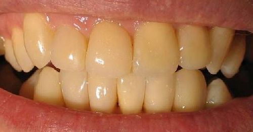 Каким образом можно избежать желтых зубов?