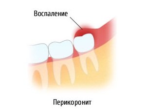 Перикоронарит