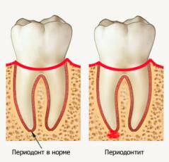 Классификация и описание периодонтитов