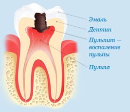 Больно ли лечить пульпит?