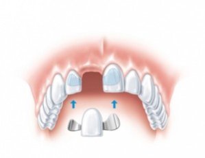 Особенности протезирования зубов при большом отсутствии
