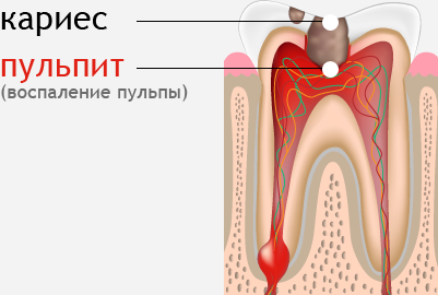 Больно ли лечить пульпит?