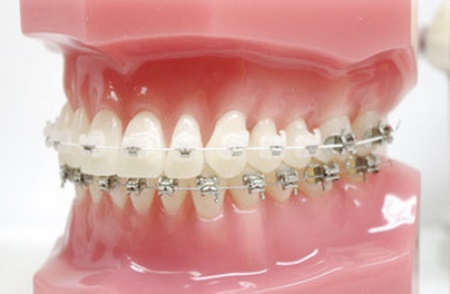Безлигатурные конструкции на зубы