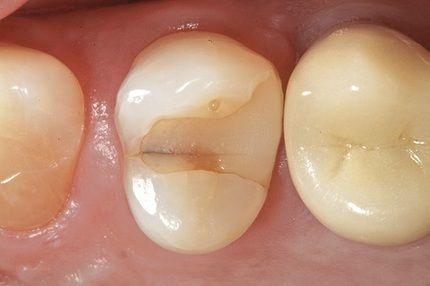Почему болит зуб после пломбирования?