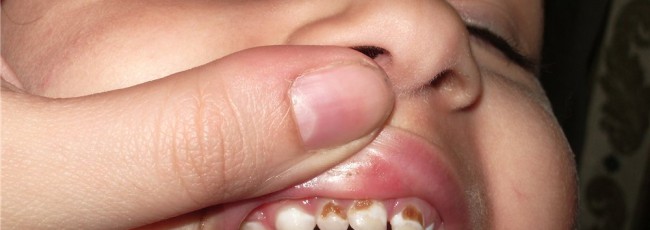 Гнилые зубы и опасность для организма