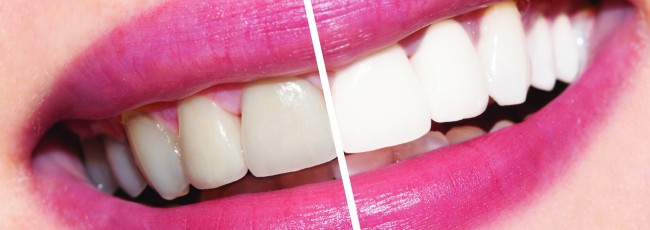 Эффективное и безопасное отбеливание зубов