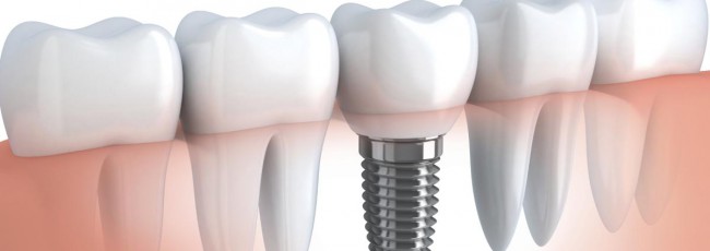 Некоторые дополнительные моменты при протезировании зубов