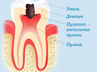 Больно ли лечить пульпит?