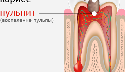 Больно ли лечить пульпит?