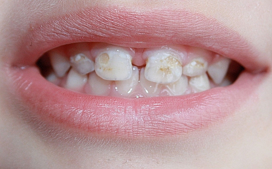 Молочные зубки и пульпит