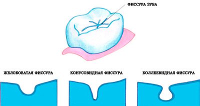 Герметизация фиссур и ее стоимость