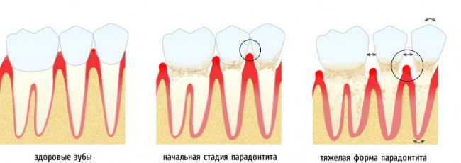 Как лечить пародонтит?